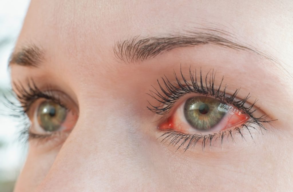 Close-up image of a woman's eyes with visible symptoms of pink eye.