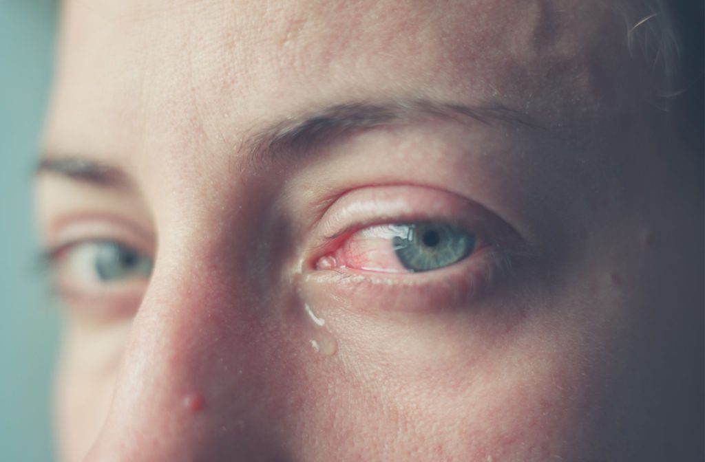 A person's eye is red, swollen, and watering due to a corneal abrasion from wearing contact lenses.